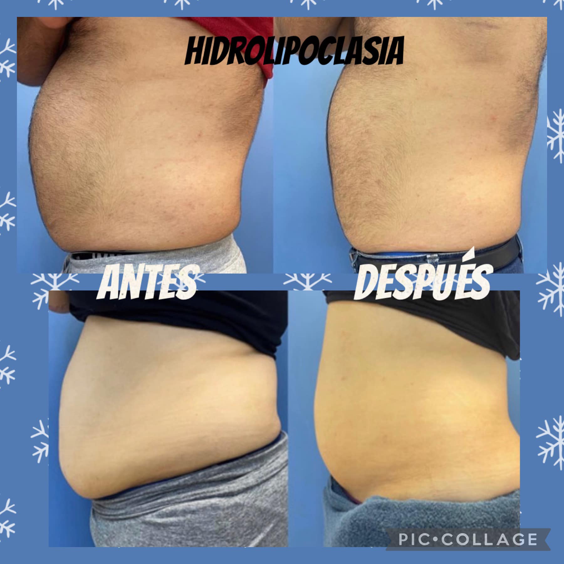 Antes Hidrolipoclasia